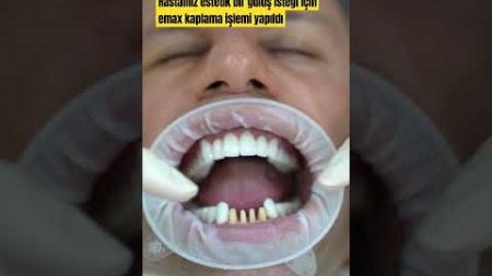 emax #music #cover #newmusic #singer #dentist #artist #dentalclinic #ciltbakımı