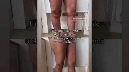 Traitez votre cellulite avec la meilleure technologie Rendez-vous et tarifs WHATSAPP 0767951141