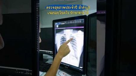 ผมยังคงสนับสนุนให้ตรวจสุขภาพประจำปีเพื่อสำรวจตัวเองเสมอ ถ้าเจอรอยโรคไว ก็จะสามารถรักษาให้หายได้ครับ