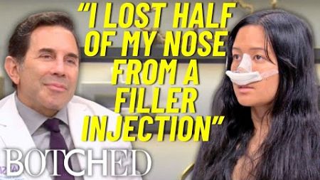 Non-Surgical Nose Job Nightmare: Melissa Lost Half Her Nose | Botched | E!