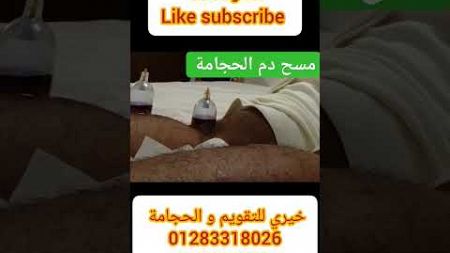 #asmr #massage #wet #cup #cupping #therapy #hijama #chiropractic #manual #therapy #الحجامة #حجامة