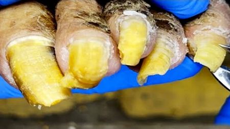 The Complete Trimming Process Of Onychomycosis, Each Nail Is Restored To Health【Pedicure King】