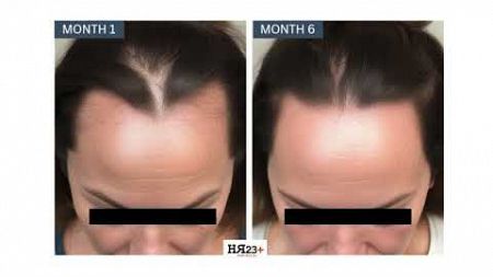 Female Hair Loss Treatment Plan Six Months Case Study Before &amp; After Results