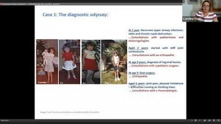 MPSS5M4 Exploring Real World Case Studies to Help You Spot the Early Signs of Mucopolysaccharidosis